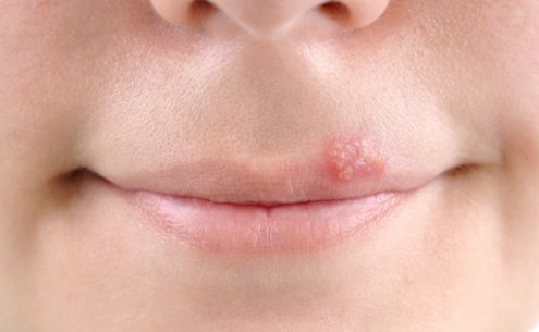 Verão, Sol e herpes labial: existe relação?