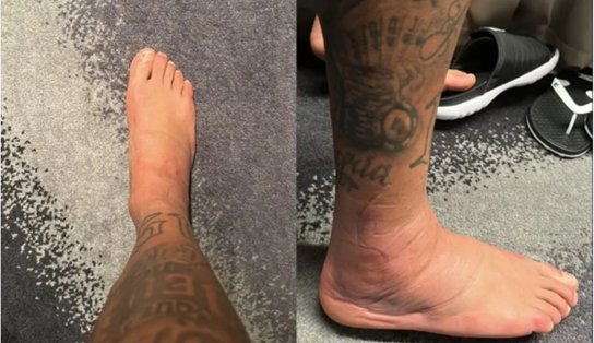 Neymar posta foto de tornozelo inchado e preocupa torcedores