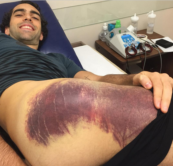 Jogador de basquete exibe hematoma, após pancada sofrida no Pan