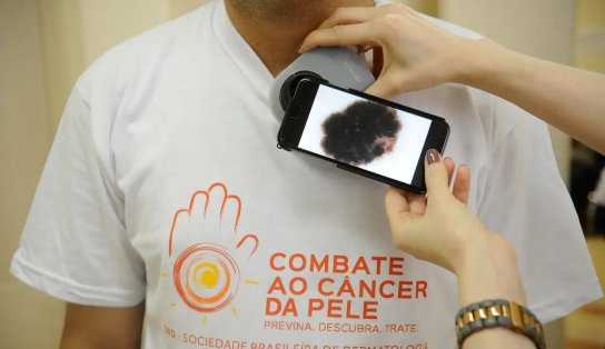 Dia de Combate ao Câncer de Pele: mutirão atende gratuitamente em todo o país 