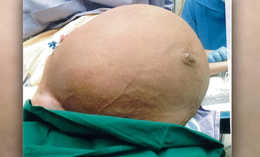 Tumor de quase 30 quilos é retirado de abdome de mulher