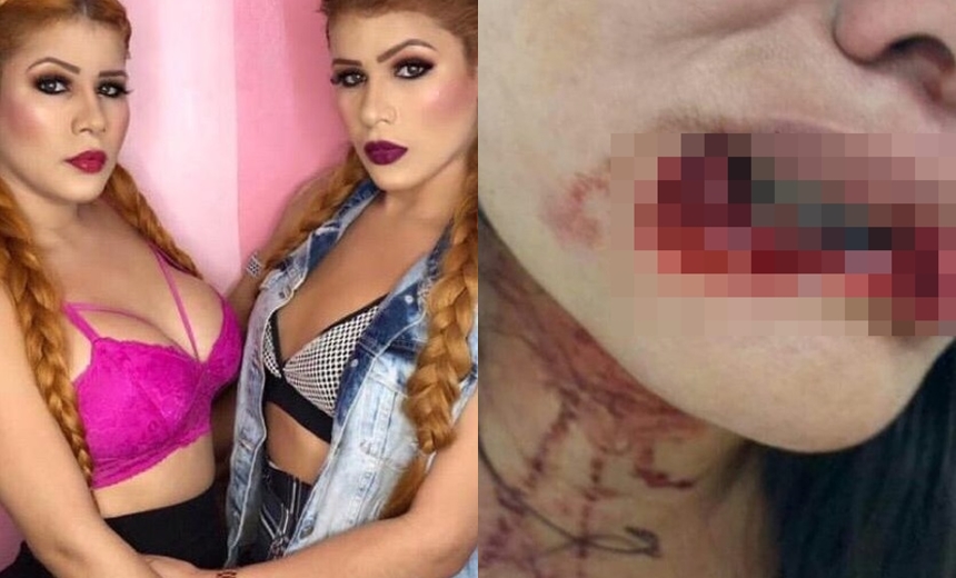 Blogueira se envolve em briga e ?arranca? lábio de outra mulher com mordida