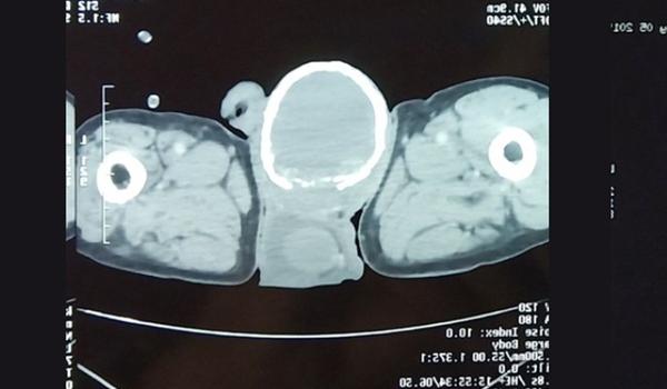 Homem desenvolve rara doença que faz crescer "casca de ovo" em seu testículo