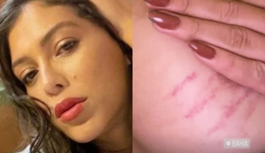 Atriz transexual é agredida em viagem a Bahia e faz vídeo mostrando hematomas: “Transfobia”