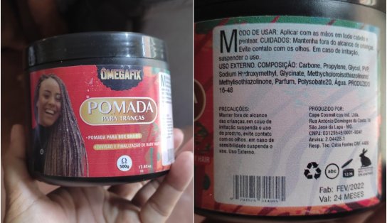 Anvisa proíbe comercialização de pomada para tranças que causou queimaduras nos olhos de uma mulher; entenda o caso