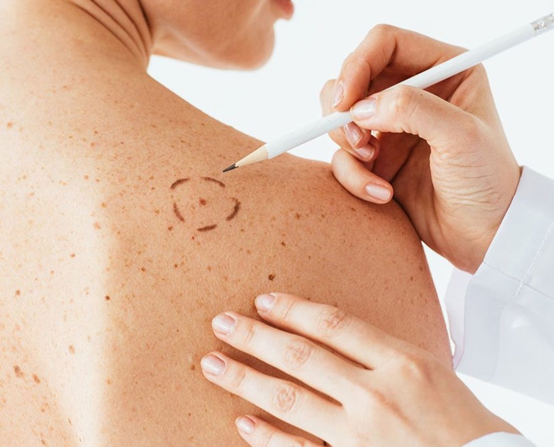 Dermatologistas alertam sobre o melanoma, câncer de pele mais agressivo; confira cuidados e fatores de risco