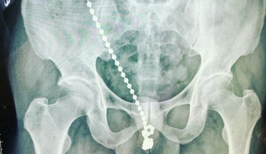 Após ter introduzido corrente de metal na uretra, homem tem pênis operado; ele alega sentir “choques elétricos”