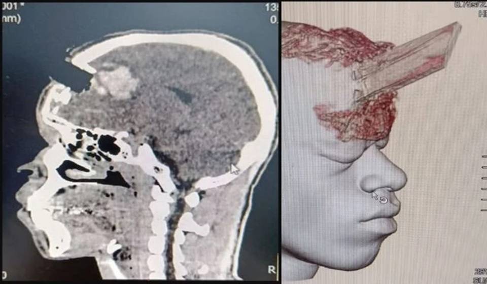 Durante serviço, estaca atravessa cabeça de pedreiro e objeto é retirado em cirurgia; saiba mais