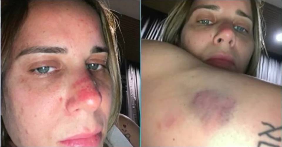 Bancária denuncia ex-marido por agressões sofridas: 'disse que me deixaria tetraplégica'