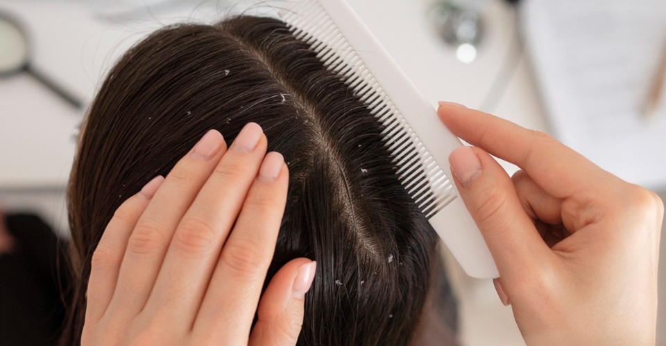 Sofre com caspa? Confira dicas de como tratar o cabelo